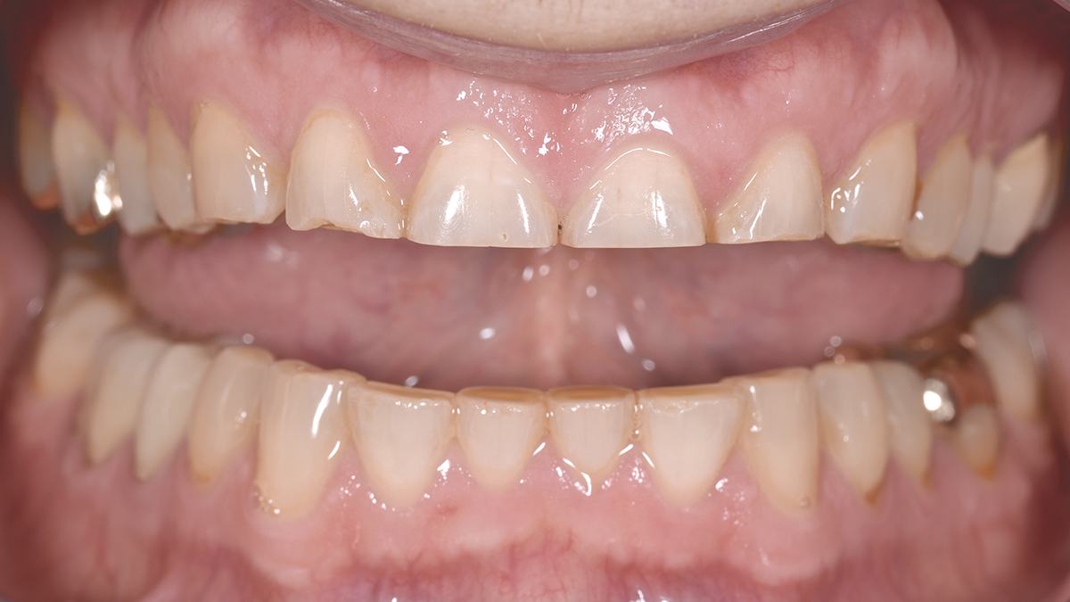 Clinical Condition before placing Celtra Press restorations