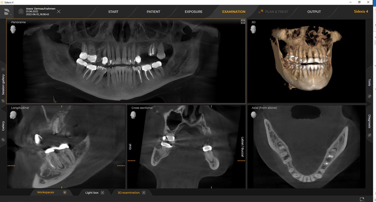 3D-röntgenfoto Ø 11 cm x 10 cm HD