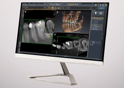 Monitor met de dentale software SICAT Endo