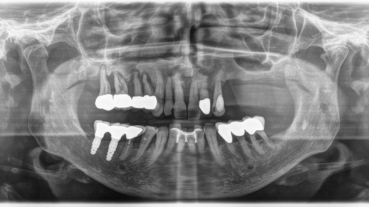 Röntgenfoto met implantaten