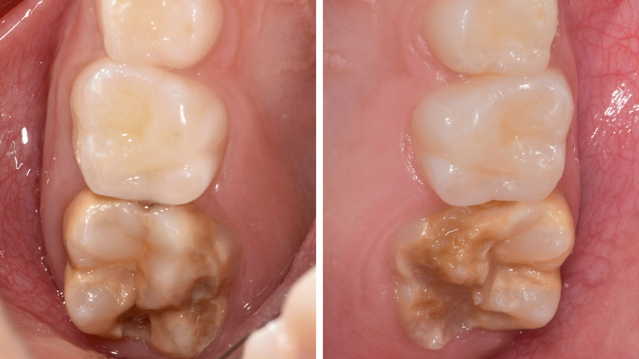 Dentes 16 e 26 afetados por hipomineralização grave. Pontuação MHI-TNI 4c (Bekes &amp; Steffen 2016)