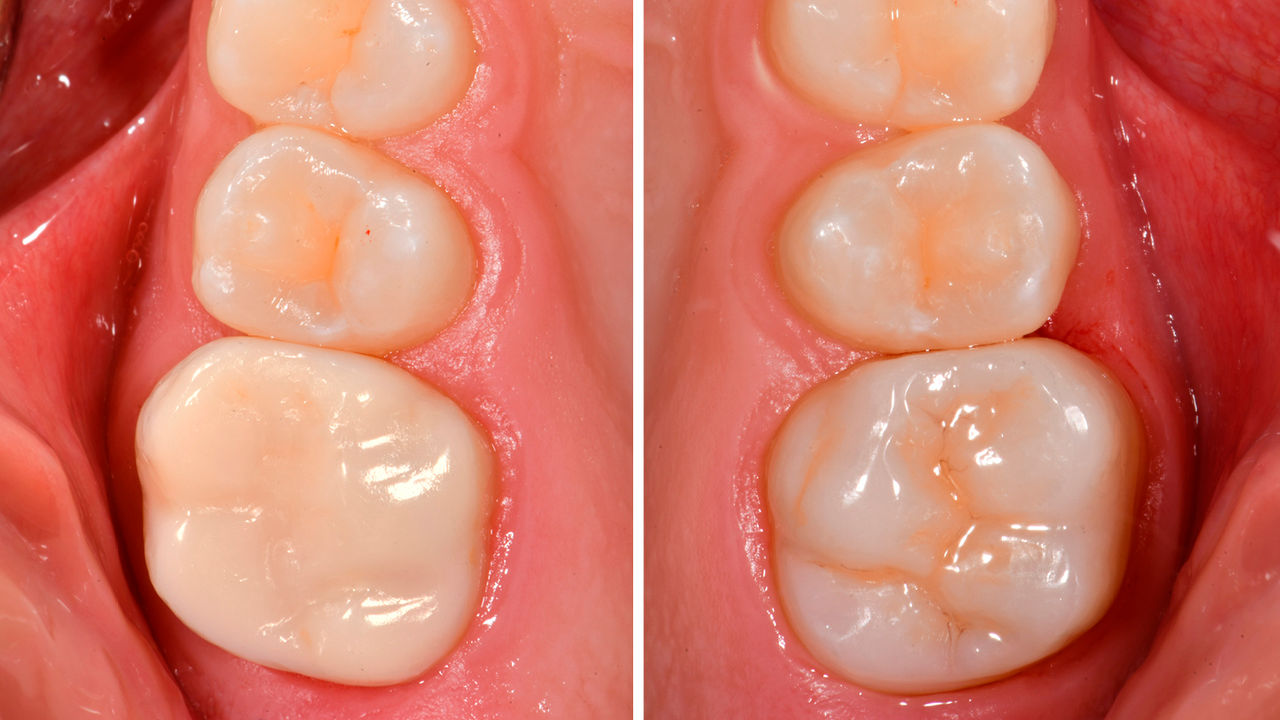 Dentes 16 e 26 após