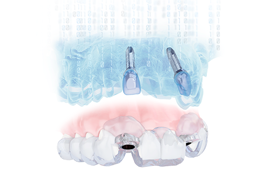 Dentsply Sirona Implants - Simplant