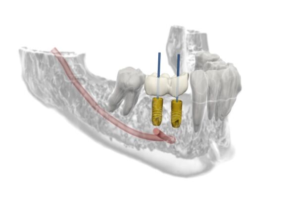 dental implant treatment planning
