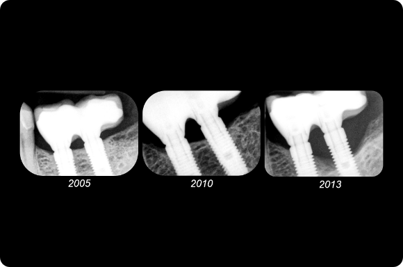 dental implant treatment planning
