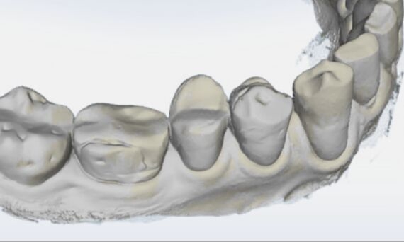 Gingival Recession Measurement, before, OraCheck