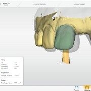 Tooth movement with OraCheck software