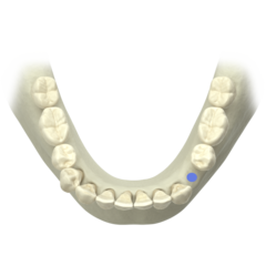 Atlantis single-tooth restoration