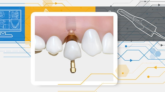 Single Tooth DS Signature Workflow