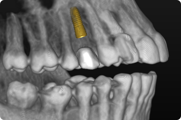 Dental implant placement