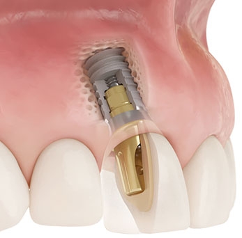 Xive implant in a jaw
