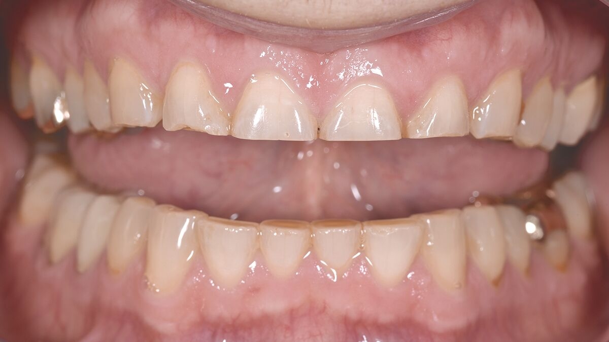 Clinical Condition before placing Celtra Press restorations