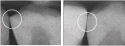 Radiograph image showing poor vs proper contact