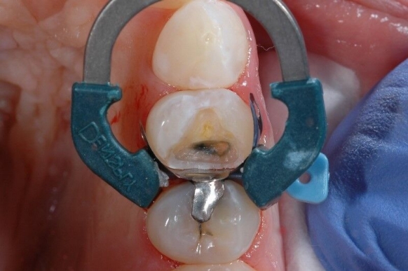 Tooth isolation to prevent saliva and blood from contaminating the restorative field