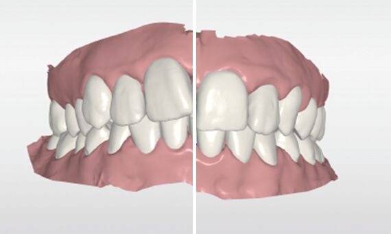 Before and after comparison with CEREC Ortho