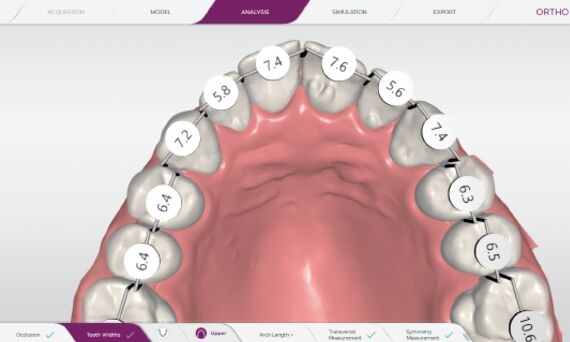 Measurement of tooth sizes