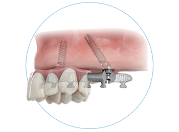 Immediate, full-arch restorations on four implants