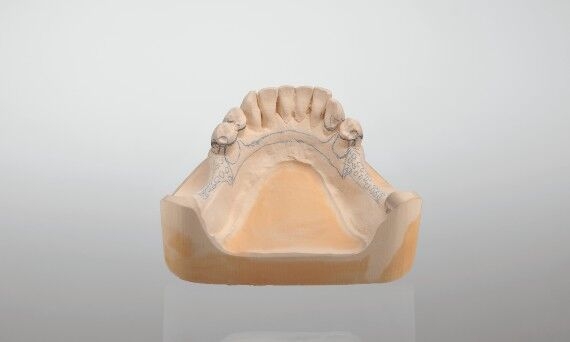 Work model for removable partial denture