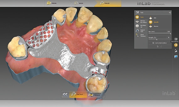 inLab CAD Software, individual adjustment of a removable denture prosthesis