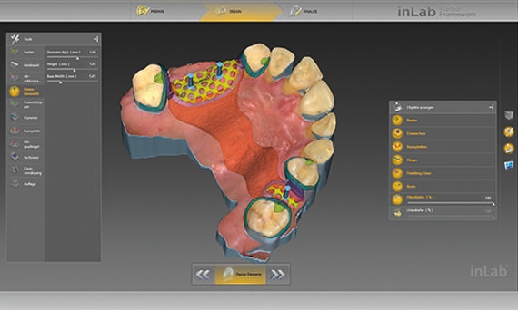 inLab CAD Software, user interface for design of removable partial dentures