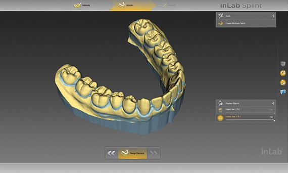 inLab CAD Software, visualization of undercuts on the digital cast