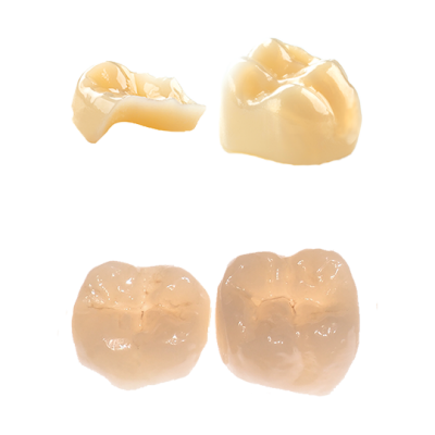 CEREC Tessera and Celtra Press posterior inlays and crowns