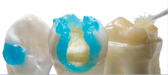 class 2 restoration adhesive example Prime&Bond Elect dental adhesive from Dentsply Sirona