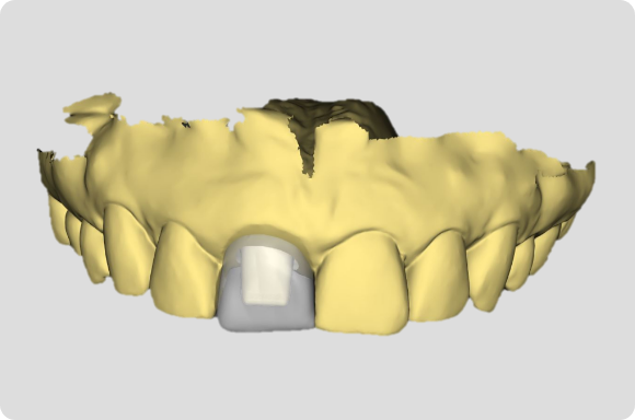 Dental Implant provisionalization