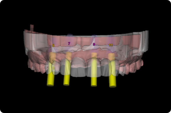 Dental Implant treatment planning