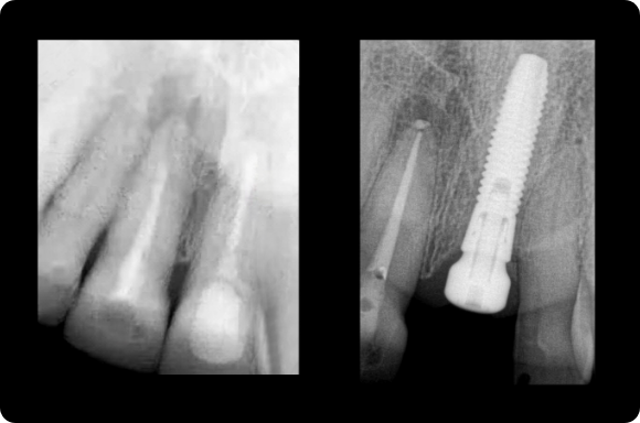 Grafting with Immediate implant placement