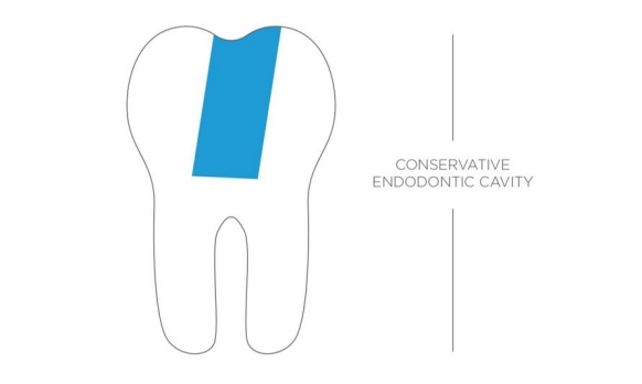 Konservatif Endodontik Kavite