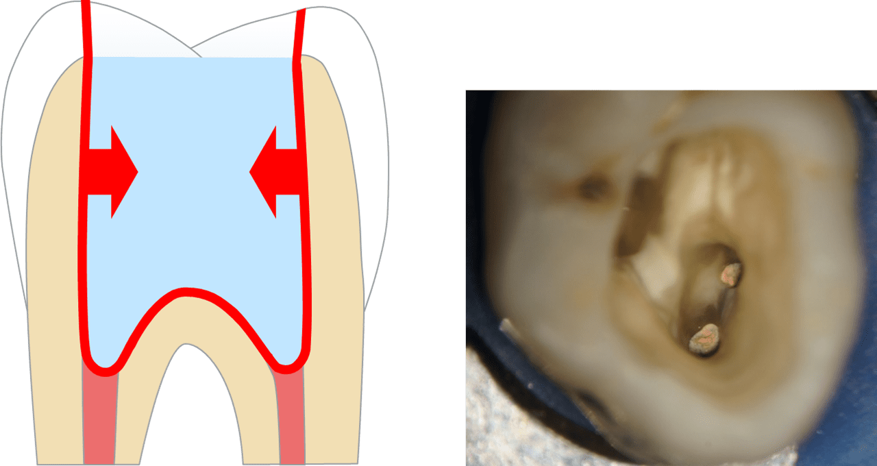 Çok miktarda dolgu malzemesinin posterior post-endodontik boşluklara yerleştirilmesi gerekir, bu da bağlı yüzeylerin miktarı boyunca önemli ölçüde büzüşme gerilimi oluşturabilir